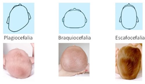 Comprar cojin plagiocefalia infantil cojin postural plagiocefalia